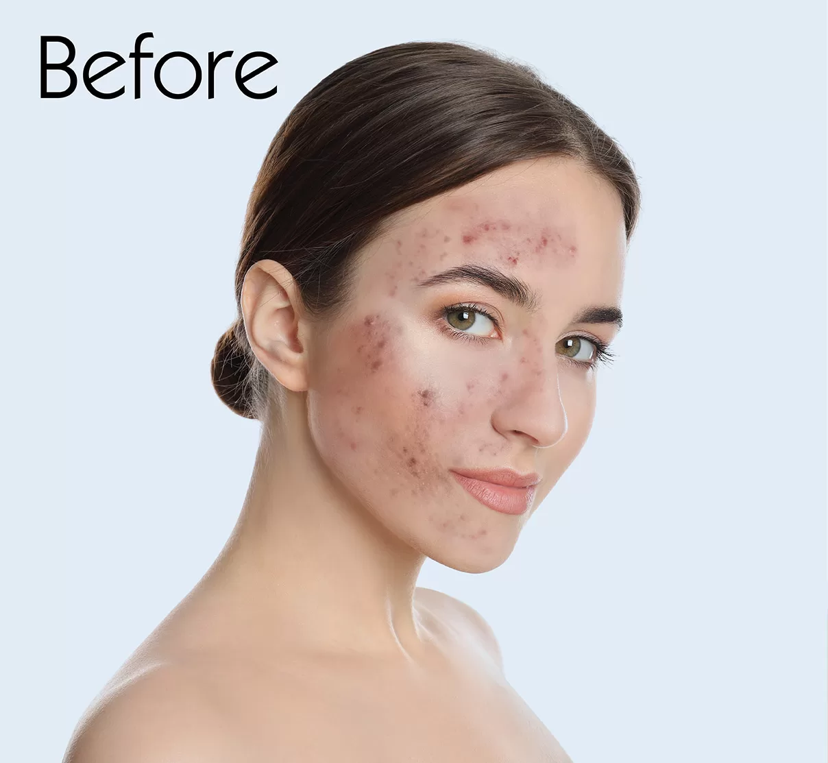 medical-chemical-peel-pine-cosmetic-clinic